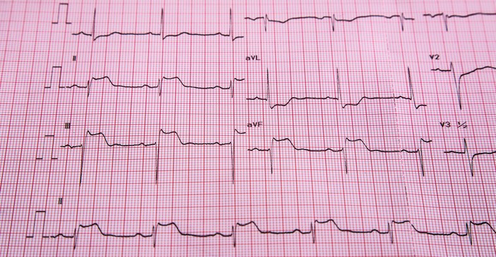 EKG - STEMI - ST pakilimo ir širdies raumens infarkto požymiai