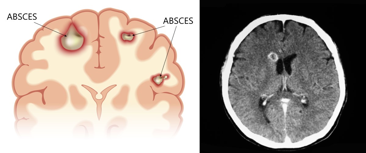 Smegenų absceso anatominiai vaizdai ir kompiuterinė tomografija