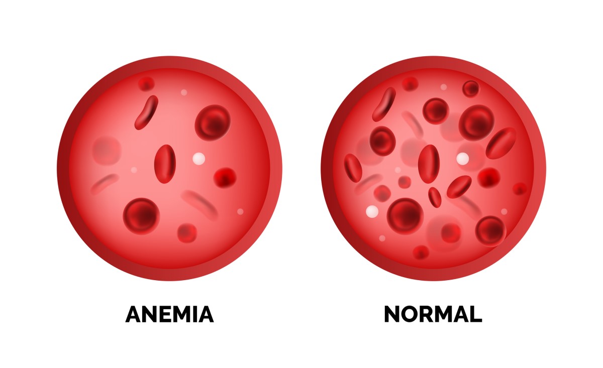 Anemija ir normalus raudonųjų kraujo ląstelių kiekis