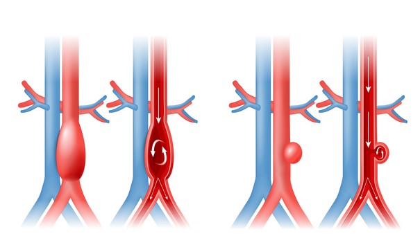 Aortos aneurizma ir kraujotaka