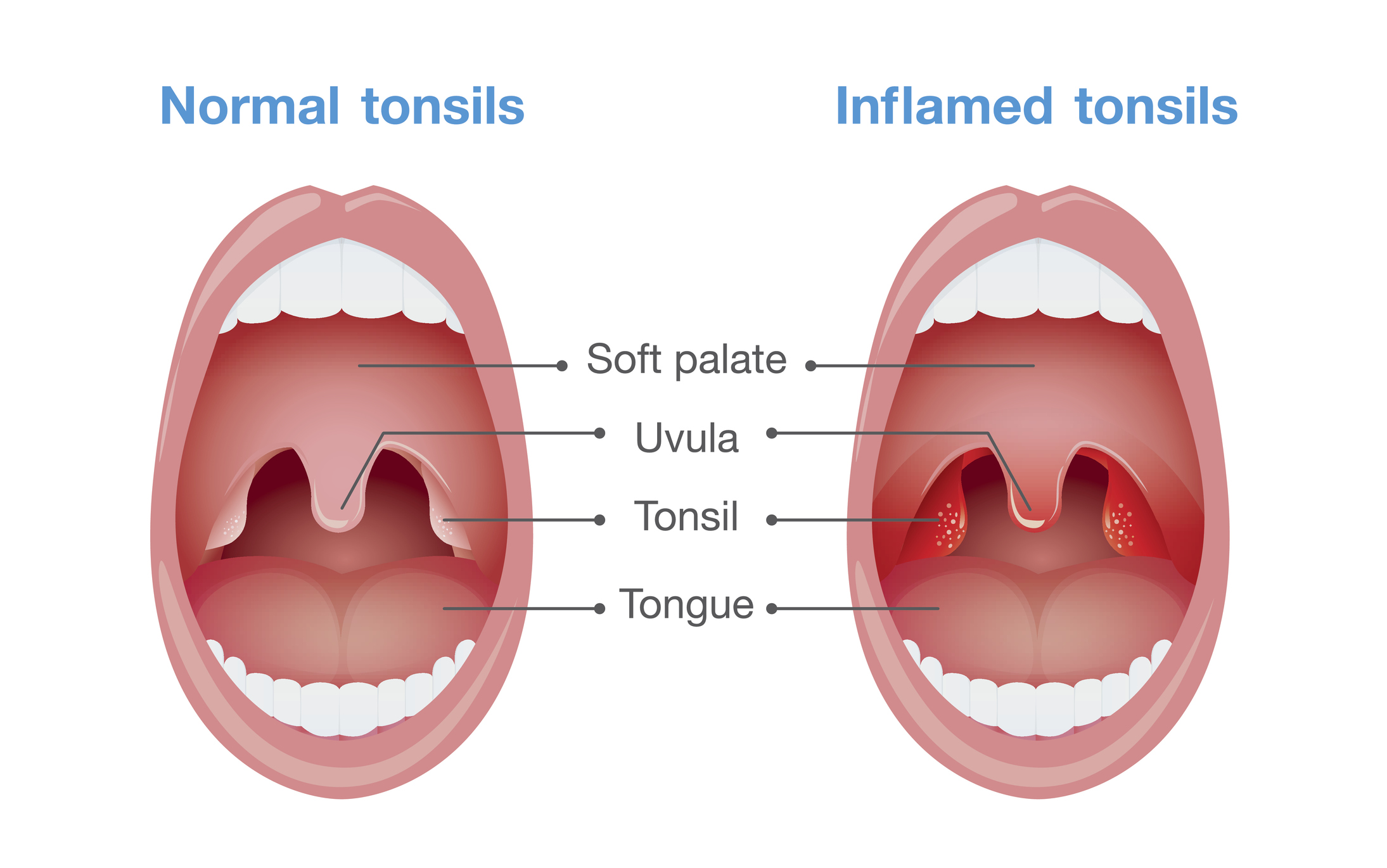 Angina - tonzilių uždegimas