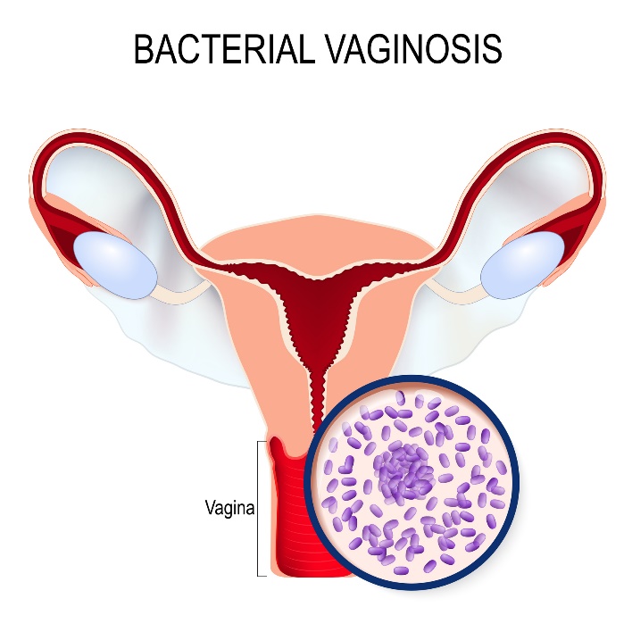 Bakterinė vaginozė ir Gardnerella vaginalis peraugimas