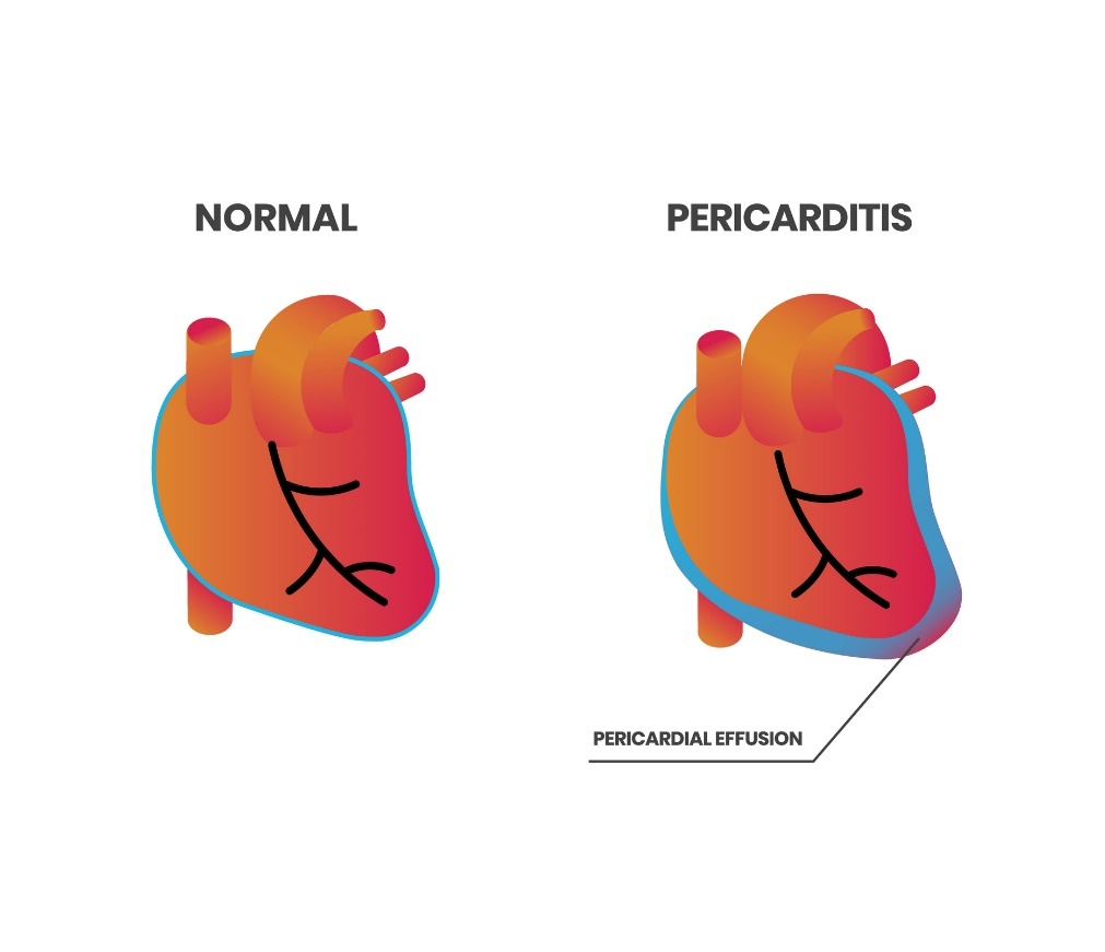 Širdies fiziologija ir perikarditas (perikardo išskyros)