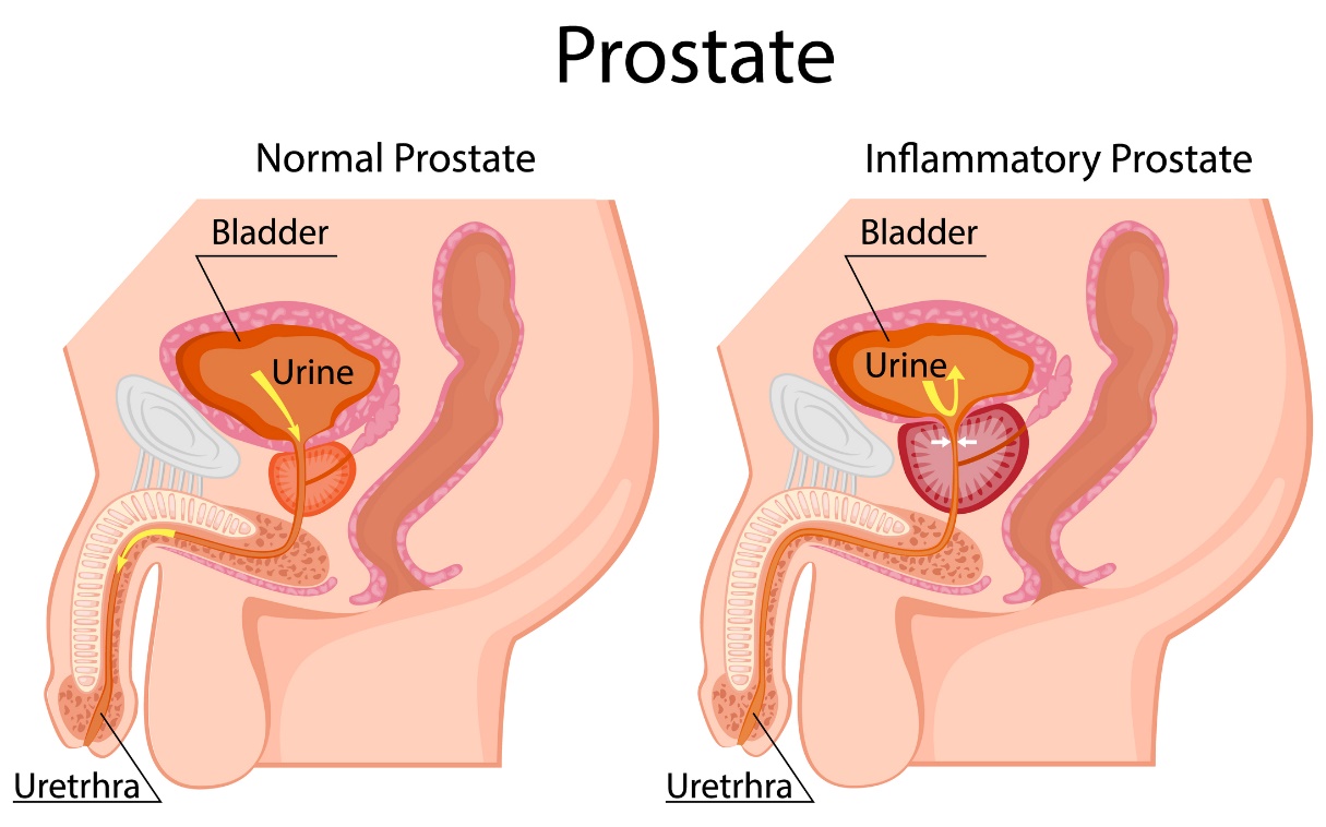 Kairėje: fiziologinė prostata. Dešinėje: padidėjusi prostata. Yra žemiau šlapimo pūslės. Šlapimo pūslė, šlapimas, šlaplė.