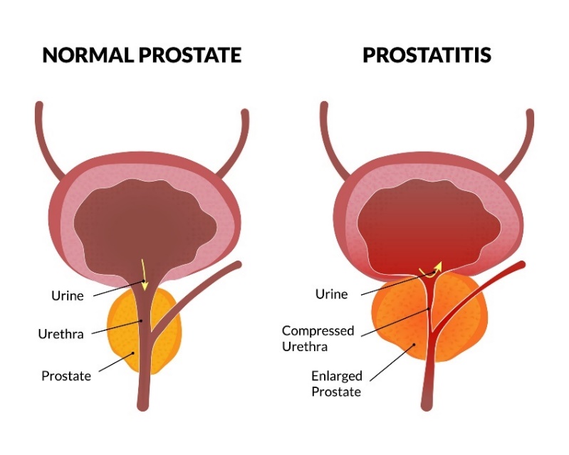 Fiziologinė prostatos būklė ir prostatitas