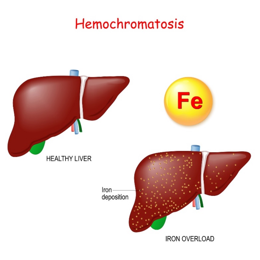 Hemochromatozė: kepenų fiziologija ir patologija, kai jose nusėda per didelis geležies (Fe) kiekis