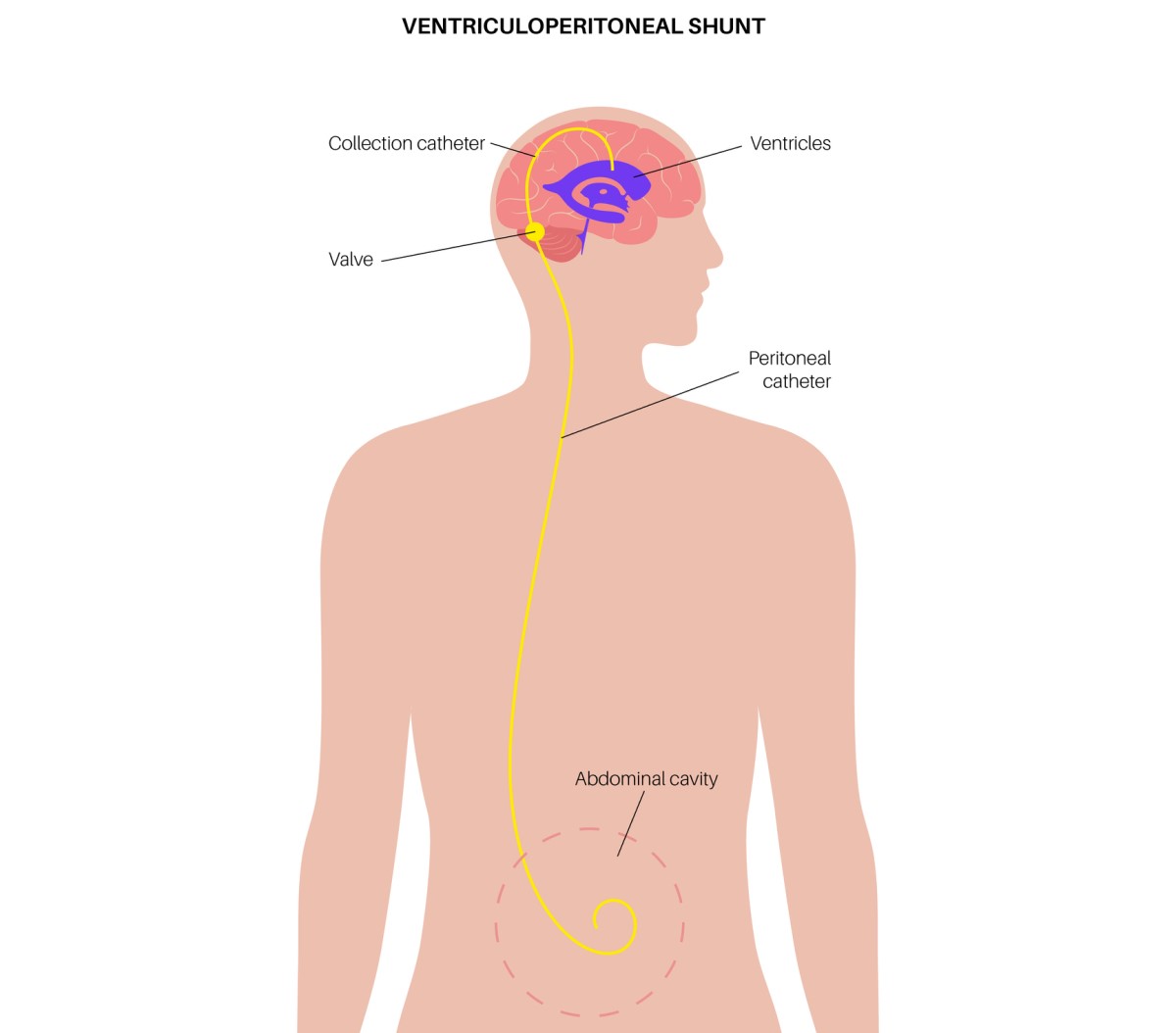 Ventrikulo-abdominalinio šunto, kuriuo skysčio perteklius iš smegenų išleidžiamas į pilvo ertmę, iliustracija.