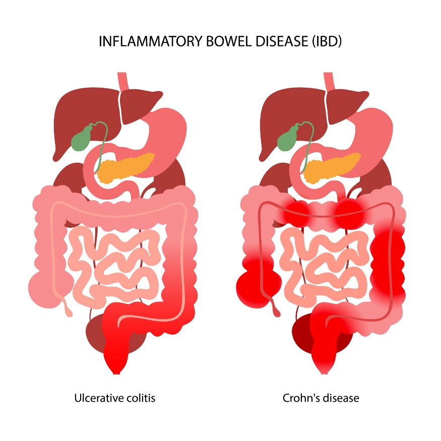 IBD: skirstoma į opinį kolitą ir Krono ligą pagal uždegiminės reakcijos lokalizaciją.