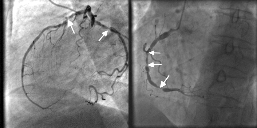 Koronarografija, angiografija, vainikinių arterijų užsikimšimas