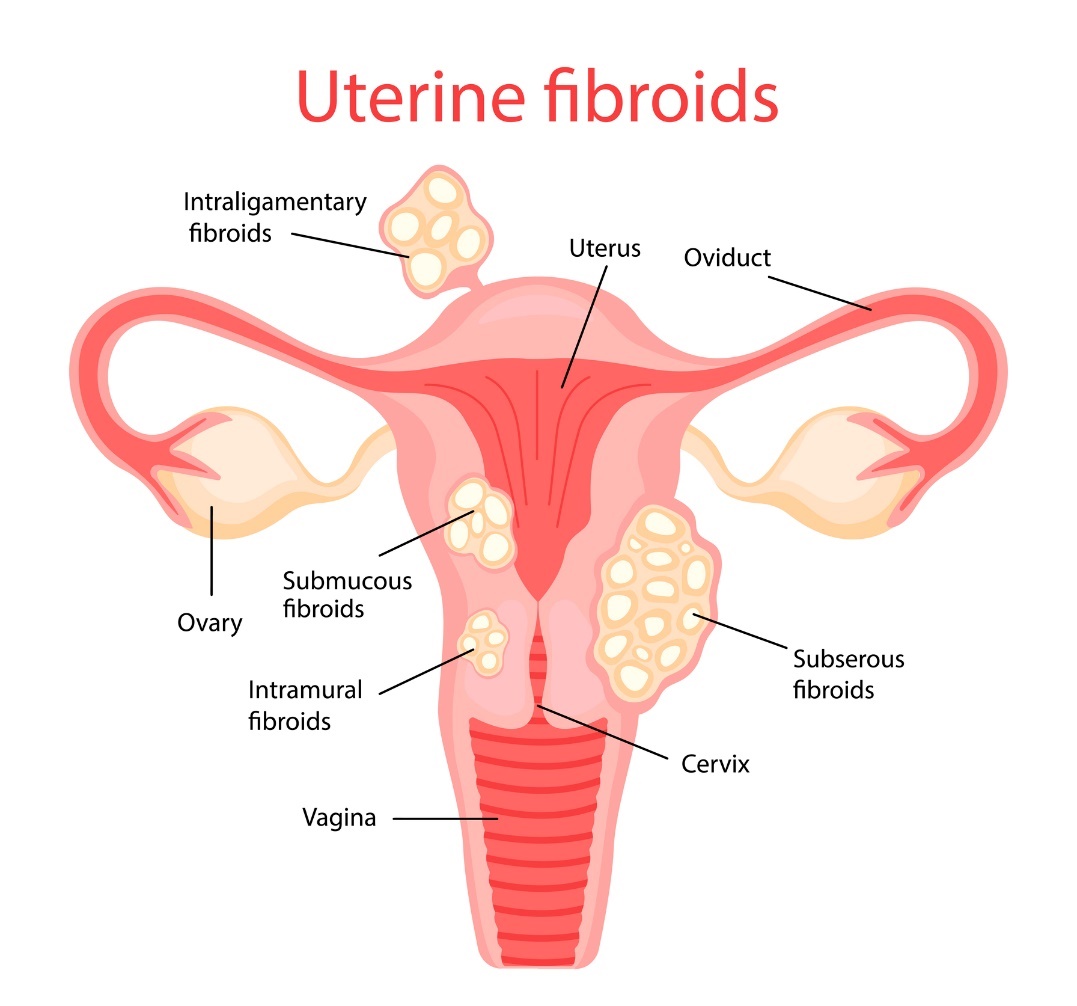 gimdos fibroidai