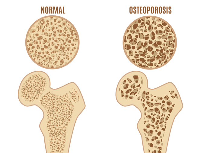 Šlaunikaulio osteoporozė