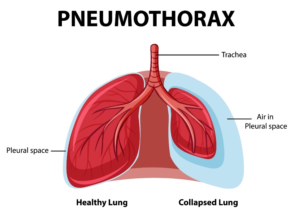 Pneumotoraksas: sveiki ir griūvantys plaučiai