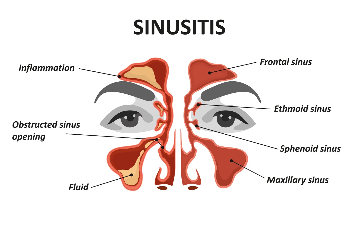 Animuotas sinusito ir sinusito modelis/vaizdas