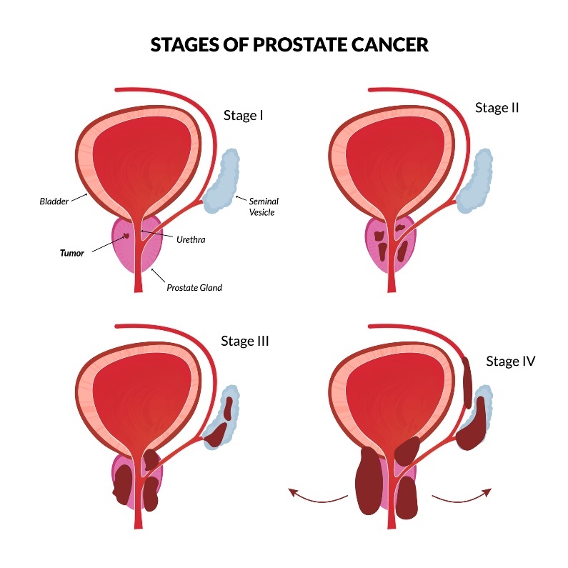 4 pagrindinės prostatos vėžio stadijos