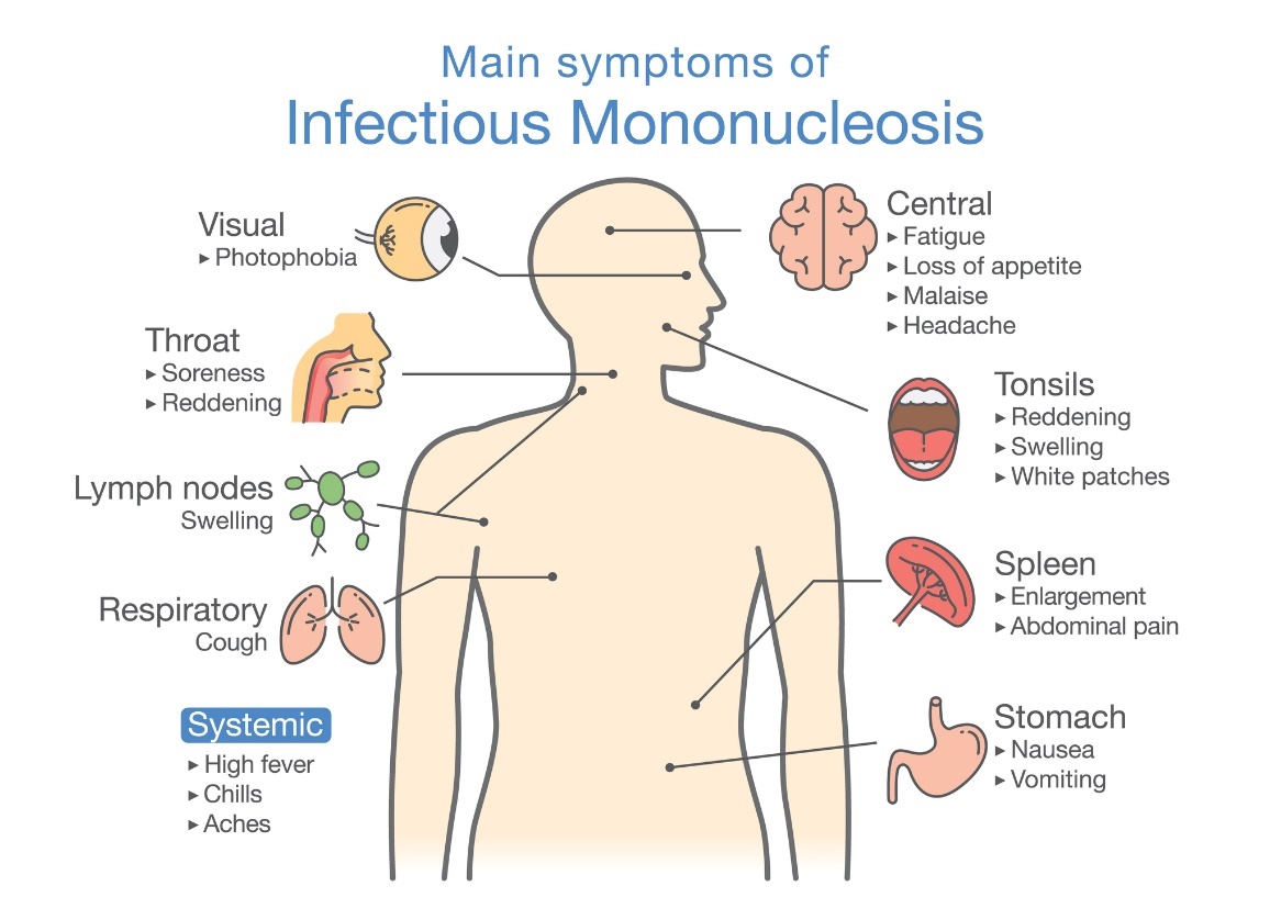 Infekcinės mononukleozės simptomai