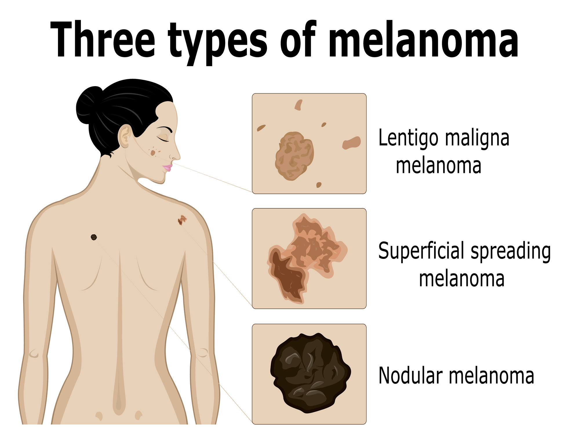 Trijų tipų melanomos vaizdavimas