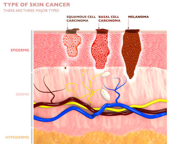 Odos navikų tipai, jų įsiskverbimas į odą - plokščialąstelinė karcinoma, bazalioma ir melanoma