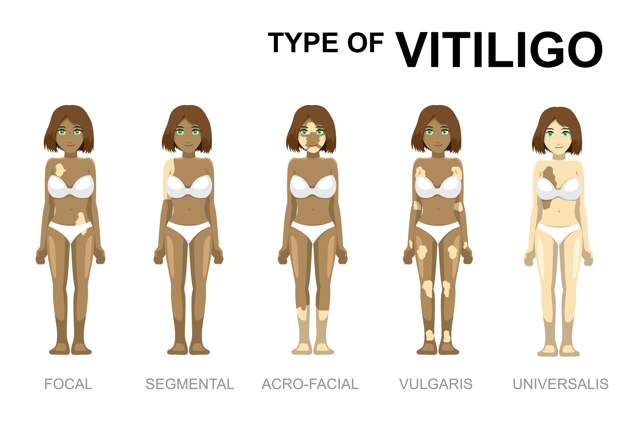 Vitiligo tipai