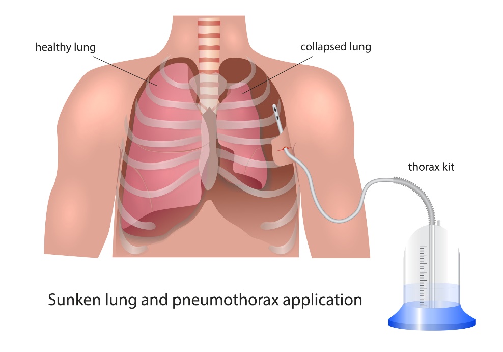 Pneumotorakso pleuros drenažo vizualizacija: sveikas plautis, sugriuvęs plautis ir drenažo įtaisas