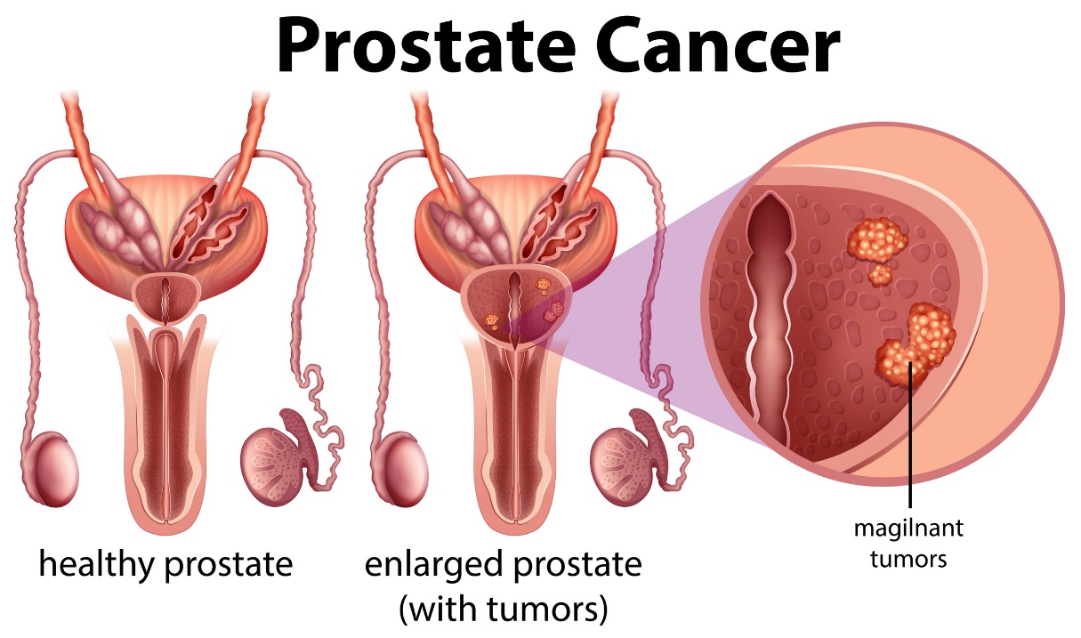 Prostatos vėžys. Sveika prostata ir padidėjusi prostata su augliu