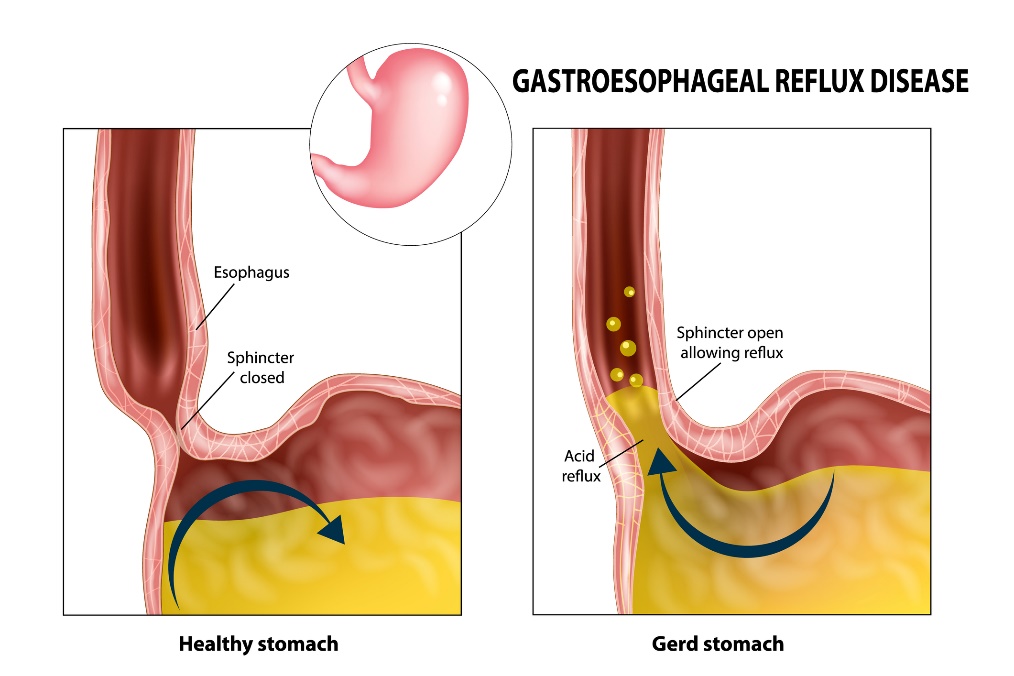 Gastroezofaginis refliuksas: stemplė, sfinkteris, skrandis ir skrandžio rūgštis