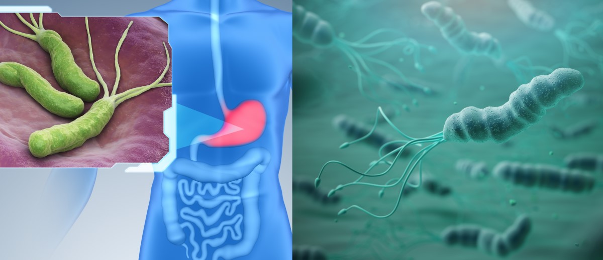 Helicobacter pylori kolonizuoja skrandžio gleivinę ir yra gastrito, opaligės ir vėžio rizikos veiksnys.