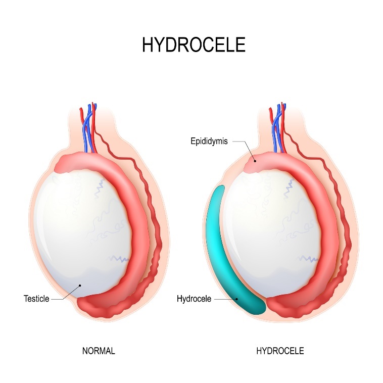 Hidrocele: sėklidė, Epididimis (sėklidė), Hidrocele (susikaupęs skystis)