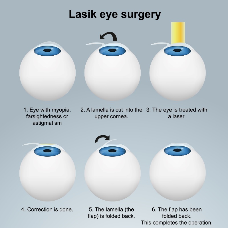 Lazerinė akių operacija LASIK - pogrindinis metodas. Procedūra su lapeliu/lapeliu nepažeidžiant nervų galūnių.