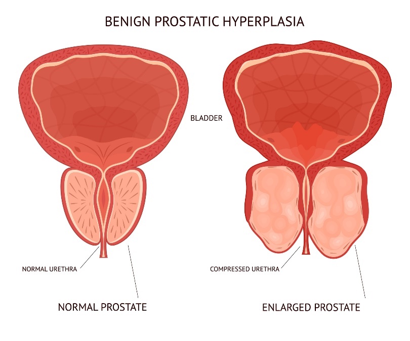 Gerybinis (nepiktybinis) prostatos padidėjimas. Pūslė (šlapimo pūslė), fiziologinis ir padidėjęs prostatos organo audinys.