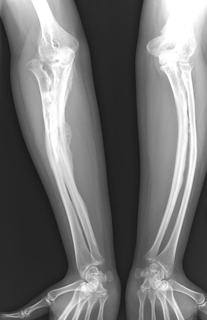 Suaugusio žmogaus osteogenesis imperfecta ligos rentgenogramos