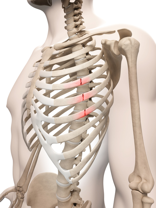 Modelis, skeletas, krūtinė, lūžę šonkauliai