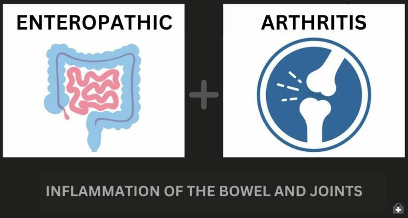 Enteropatinis artritas ir uždegiminė žarnyno liga: kaip jie susiję + Simptomai