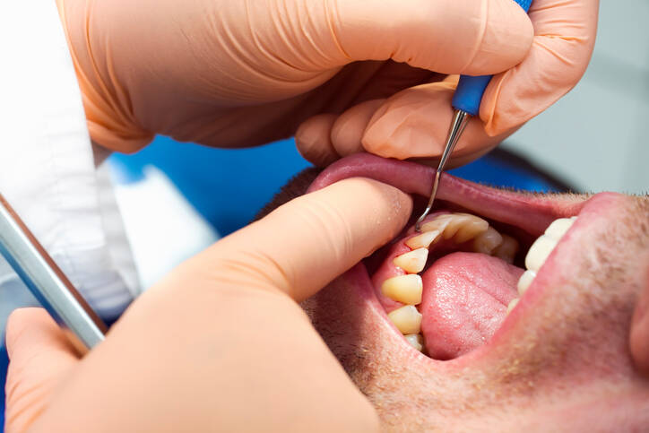 Periodonto ligos: kodėl jos atsiranda + Kaip sustabdyti dantų klibėjimą ir sustiprinti dantis?