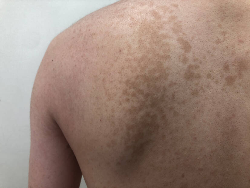 Pityriasis versicolor: kas tai yra ir kokie simptomai pasireiškia? Priežastys ir perdavimas