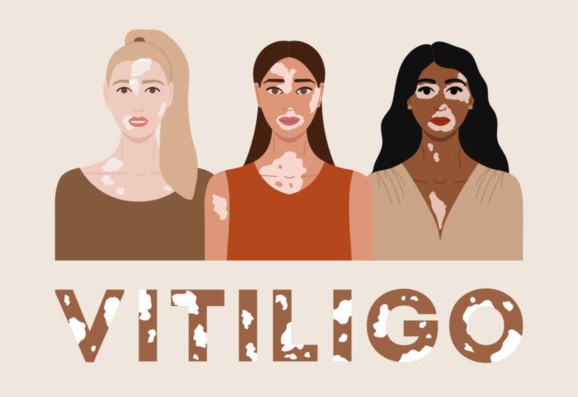 Vitiligo: kas yra vitiligo, kokios yra jo priežastys ir simptomai? Kada jis prasideda?